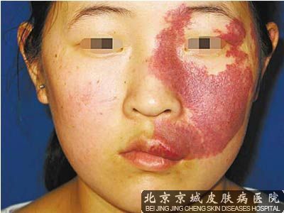 怎样去除红色素沉淀