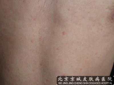 全身出疹子