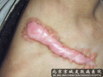 蟹足肿怎么办
