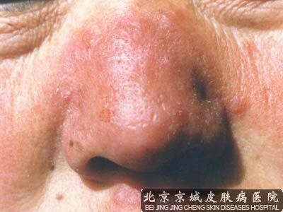 慢性酒渣鼻可以 吗