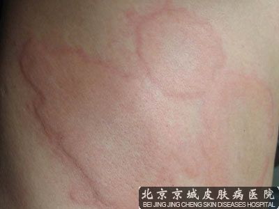 每天晚上全身发痒怎么办