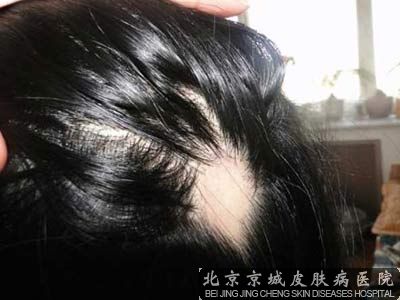 治鬼剃头专科医院哪家好