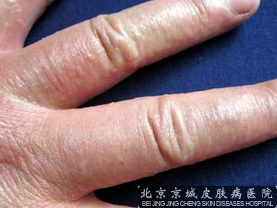 如何治疗汗疱疹