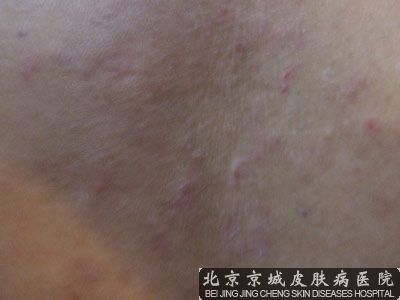 皮肤淀粉样变新疗法