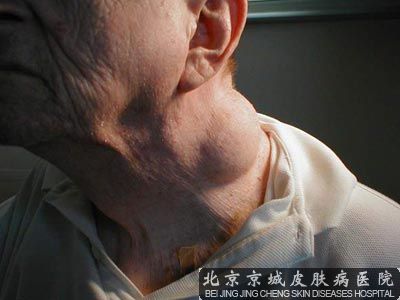 多发性脂肪瘤怎么治疗