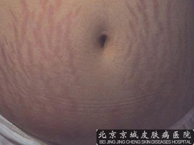 祛妊娠纹多少钱