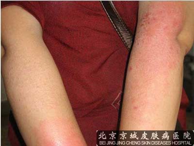 甲癣、真菌和湿疹合并感染怎么治