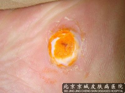 脚上长鸡眼怎么办