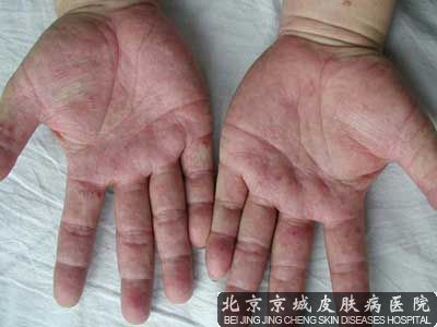 孩子身上起水泡