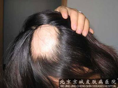 北京鬼剃头专科医院