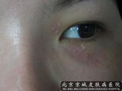 眼部汗管瘤怎么去除