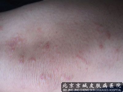 皮肤淀粉样变的治疗