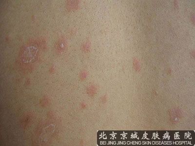 玫瑰疱疹怎么治疗