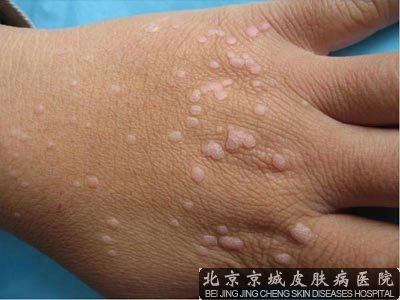 病毒疣扁平疣的治疗法