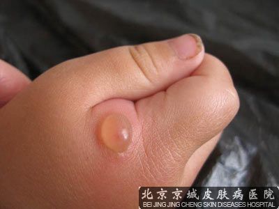 手指长小水泡