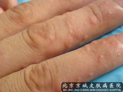 汗疱疹是怎么治疗