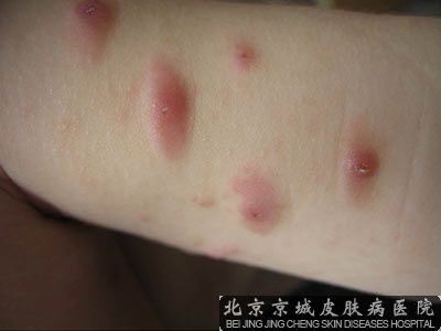 小孩荨麻疹