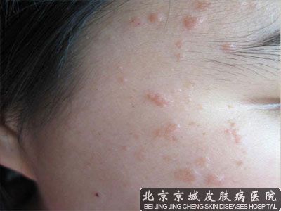 疣的治疗