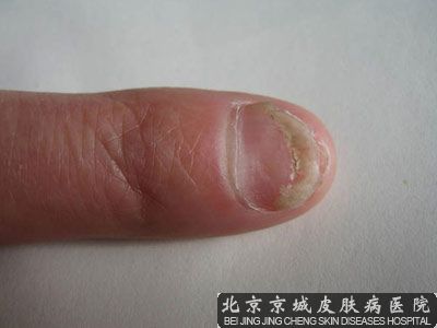 怎样治疗甲沟炎