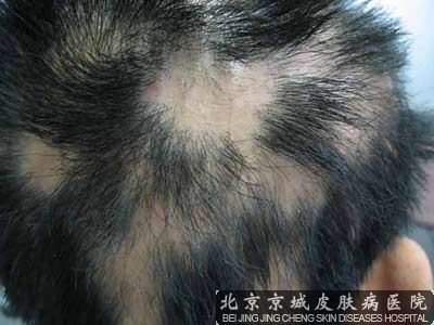 斑秃北京那家医院好