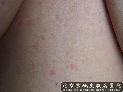 身上出现小红点
