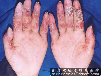 红斑狼疮是什么病能活多久