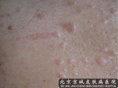 治疗跖疣得花多少钱