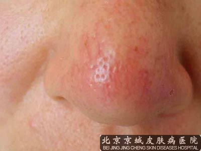 中西结合治疗酒糟鼻