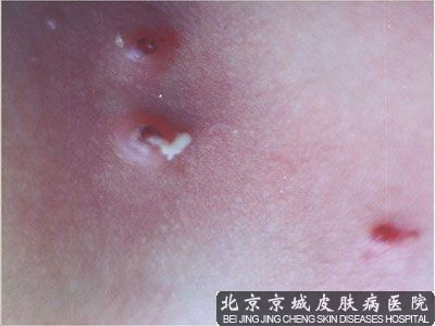 儿童病毒性软疣怎么治