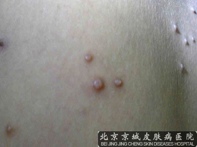 传染性软疣好治吗