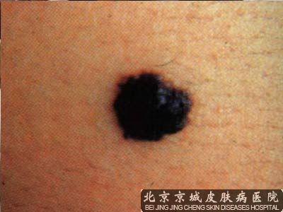 去痣挂什么科