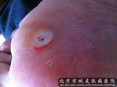 鸡眼切除术要多少钱