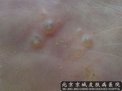 脚上病毒疣怎么治