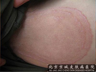 大腿内侧股癣怎么治