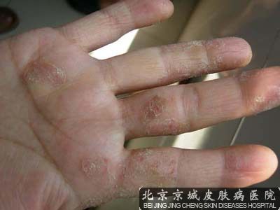 手指头上长小水泡