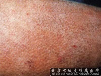 皮肤淀粉样变哪里治疗