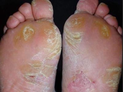 医院看掌趾脓包上哪家医院好