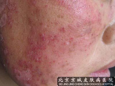 北京治疗红斑狼疮那个医院好