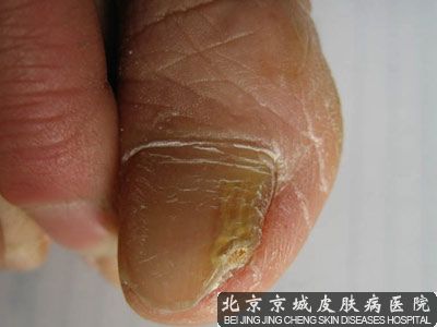 北京治疗灰指甲专业的医院