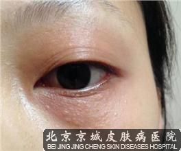 脸上汗管瘤怎么办
