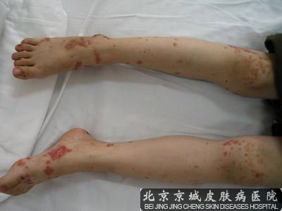 十岁过敏性紫癜怎么办