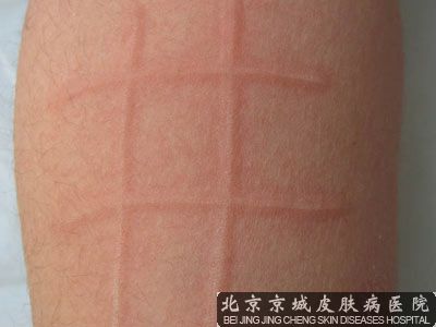 皮肤划痕症能 吗