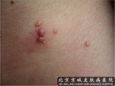 北京哪个医院治传染性软疣