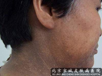 面部皮肤黑变病
