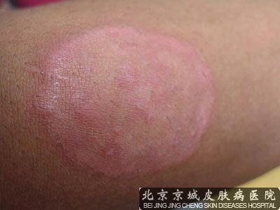 北京治疗体癣费用