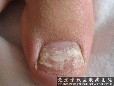 治疗灰指甲的方法