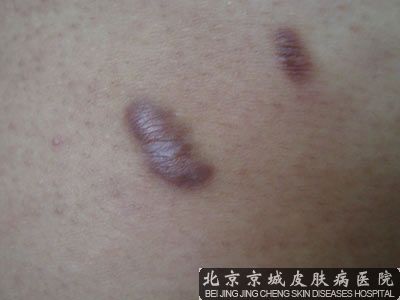 色素脱失疤痕哪家治疗比较好