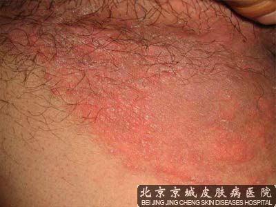 治疗股癣较好的方法