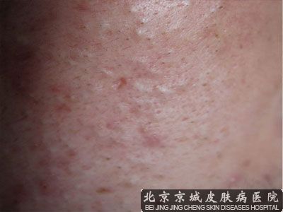 强效去黑头