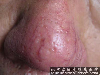 酒糟鼻四年越来越严重求果治疗方法